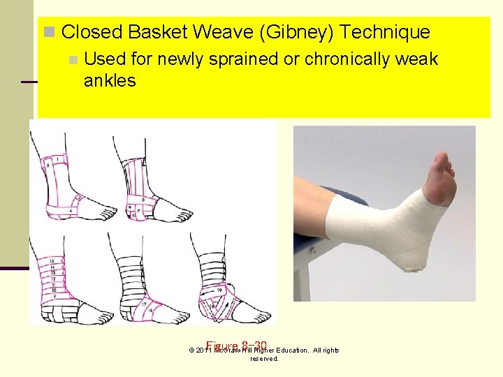 n Closed Basket Weave (Gibney) Technique n Used for newly sprained or chronically weak