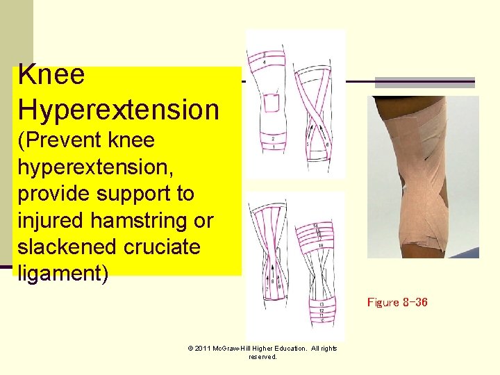 Knee Hyperextension (Prevent knee hyperextension, provide support to injured hamstring or slackened cruciate ligament)