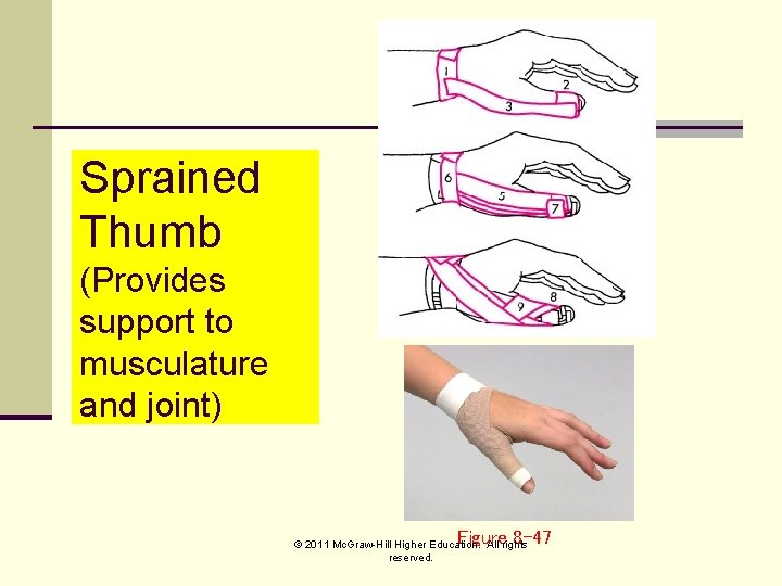Sprained Thumb (Provides support to musculature and joint) Figure 8 -47 © 2011 Mc.