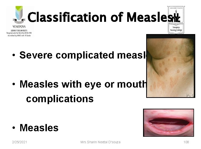 Classification of Measles • Severe complicated measles • Measles with eye or mouth complications