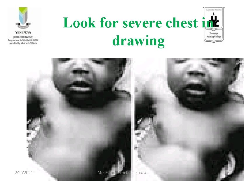 Look for severe chest in drawing 2/25/2021 Mrs. Sharin Neetal D'souza 26 