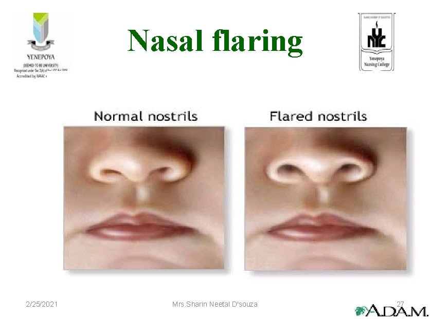 Nasal flaring 2/25/2021 Mrs. Sharin Neetal D'souza 27 