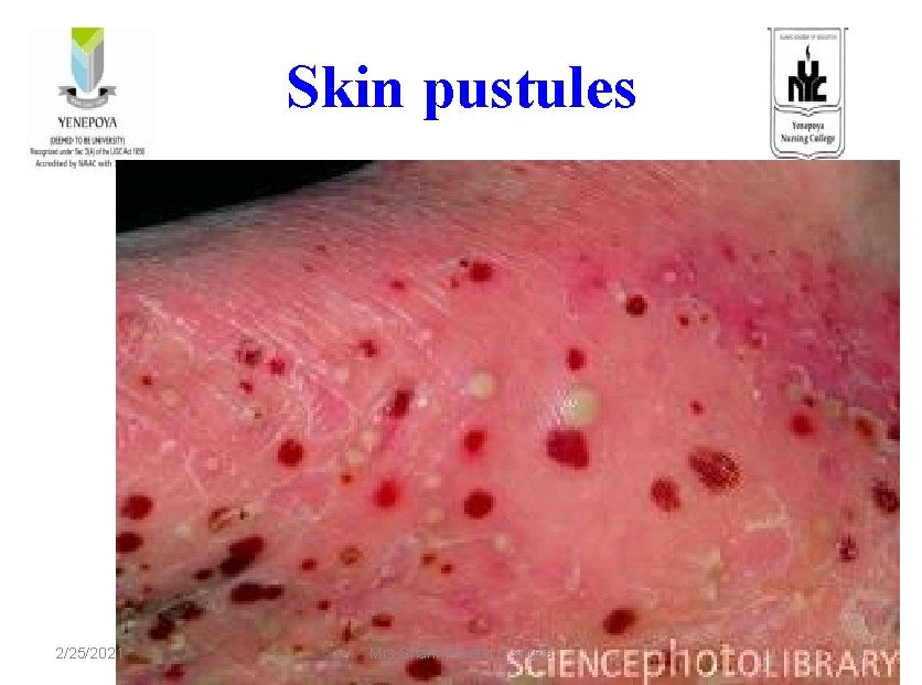 Skin pustules 2/25/2021 Mrs. Sharin Neetal D'souza 31 