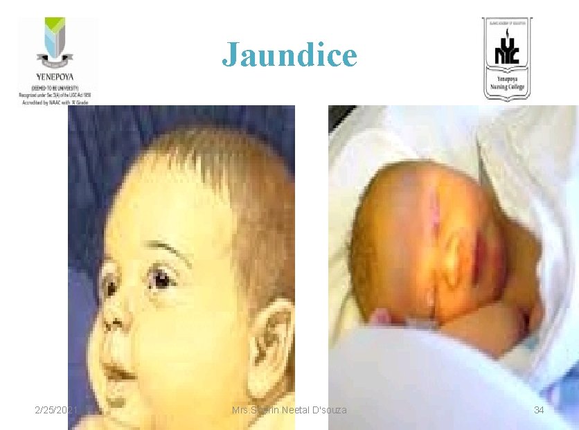 Jaundice 2/25/2021 Mrs. Sharin Neetal D'souza 34 