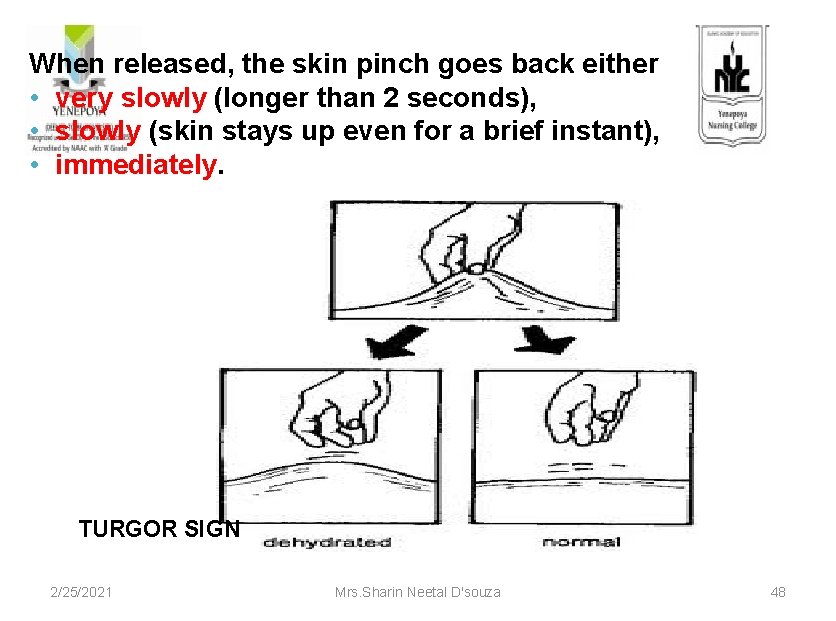 When released, the skin pinch goes back either • very slowly (longer than 2