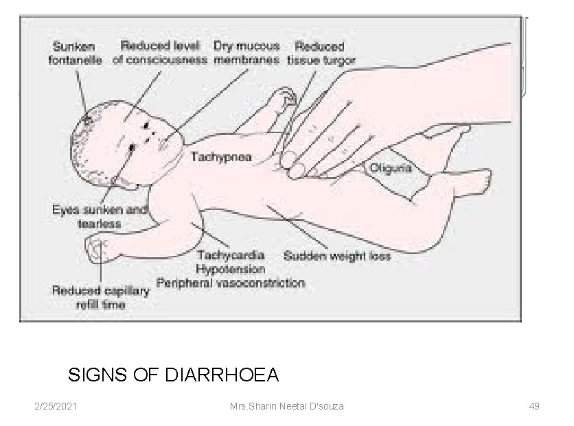 SIGNS OF DIARRHOEA 2/25/2021 Mrs. Sharin Neetal D'souza 49 