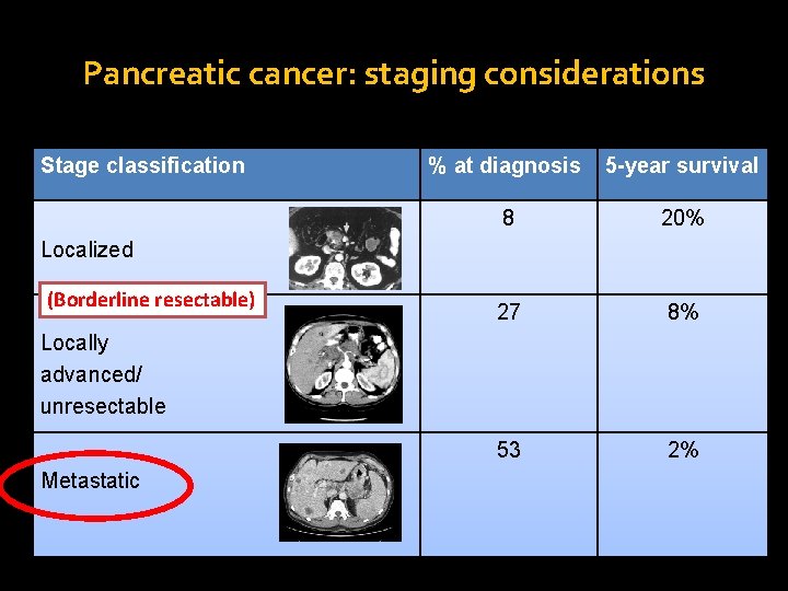 Pancreatic cancer: staging considerations Stage classification % at diagnosis 5 -year survival 8 20%