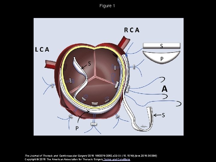 Figure 1 The Journal of Thoracic and Cardiovascular Surgery 2018 1562076 -2082. e 2