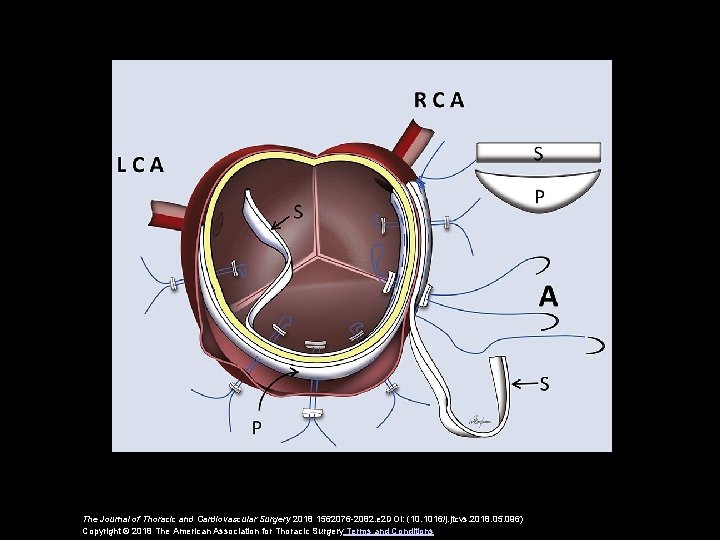 The Journal of Thoracic and Cardiovascular Surgery 2018 1562076 -2082. e 2 DOI: (10.