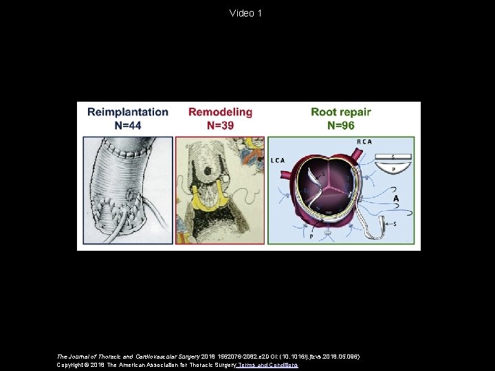 Video 1 The Journal of Thoracic and Cardiovascular Surgery 2018 1562076 -2082. e 2