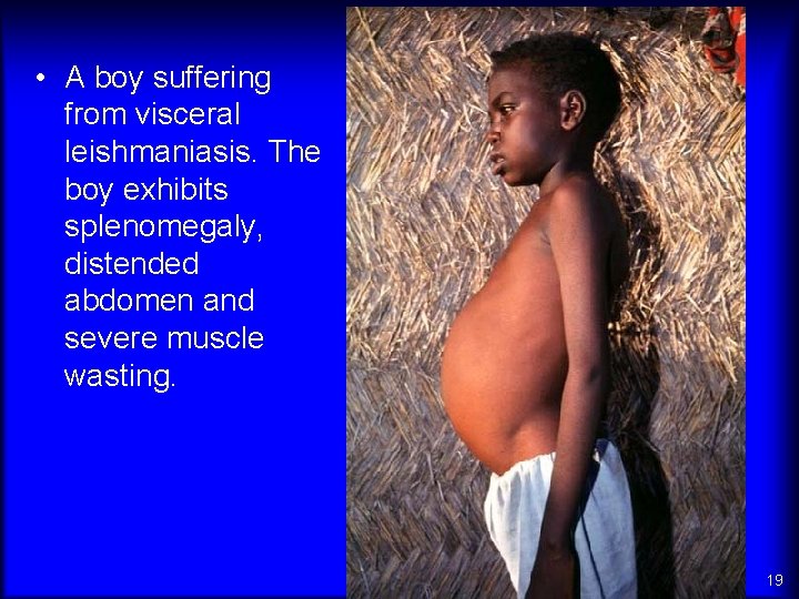  • A boy suffering from visceral leishmaniasis. The boy exhibits splenomegaly, distended abdomen