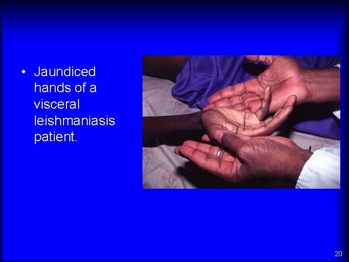  • Jaundiced hands of a visceral leishmaniasis patient. 20 