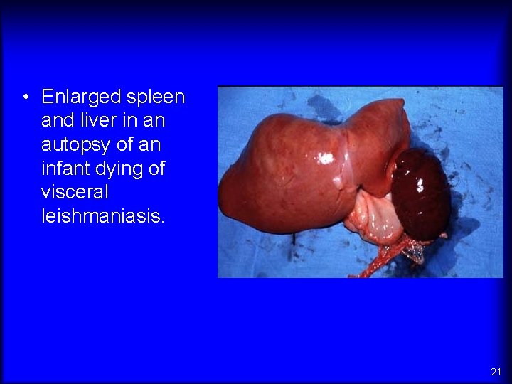  • Enlarged spleen and liver in an autopsy of an infant dying of