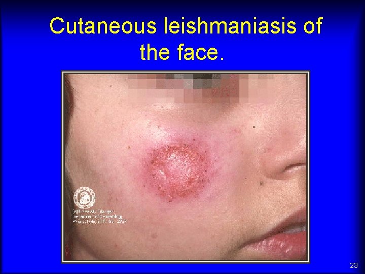 Cutaneous leishmaniasis of the face. 23 