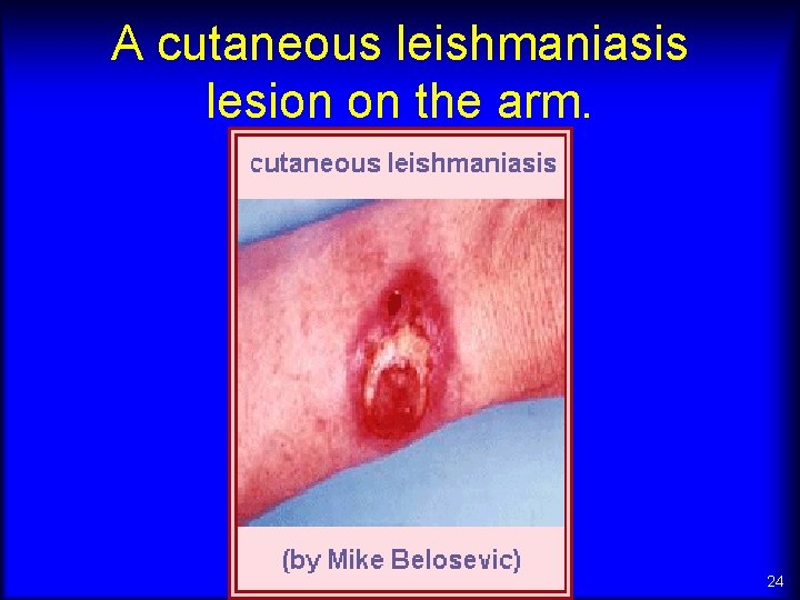 A cutaneous leishmaniasis lesion on the arm. 24 