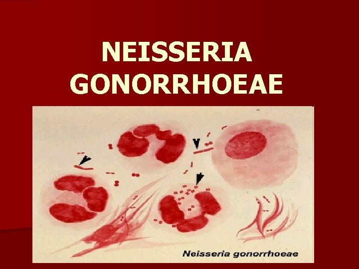 NEISSERIA GONORRHOEAE 