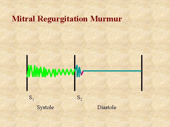 Mitral Regurgitation Murmur S 1 S 2 Systole Diastole 