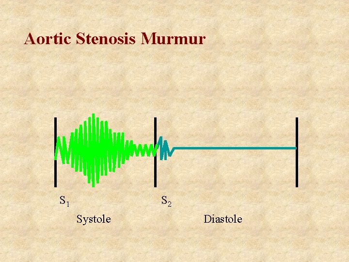 Aortic Stenosis Murmur S 1 S 2 Systole Diastole 
