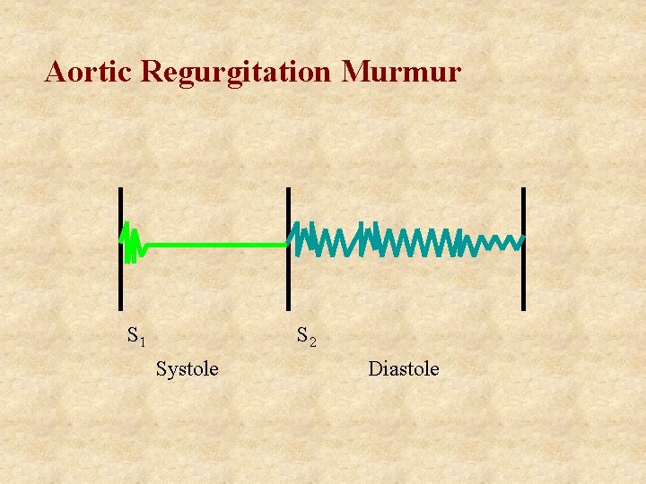 Aortic Regurgitation Murmur S 1 S 2 Systole Diastole 