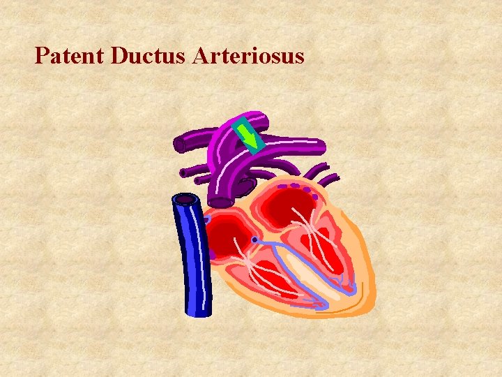 Patent Ductus Arteriosus 