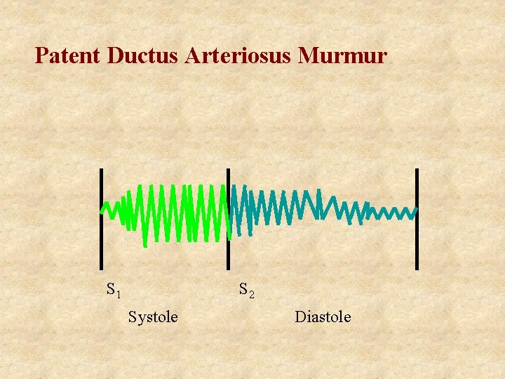 Patent Ductus Arteriosus Murmur S 1 S 2 Systole Diastole 