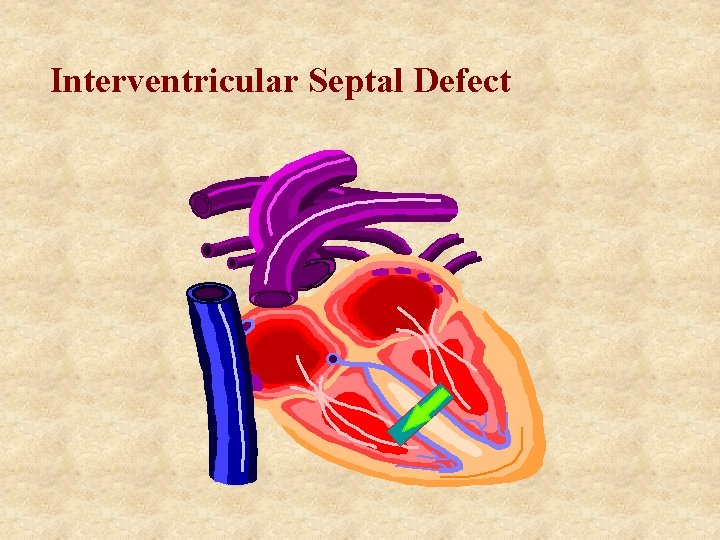 Interventricular Septal Defect 