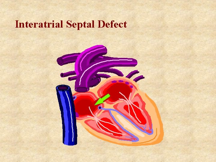 Interatrial Septal Defect 