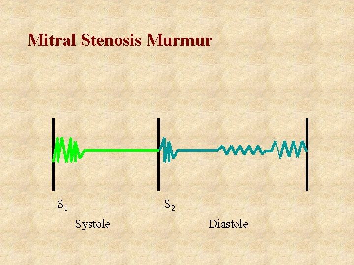 Mitral Stenosis Murmur S 1 S 2 Systole Diastole 