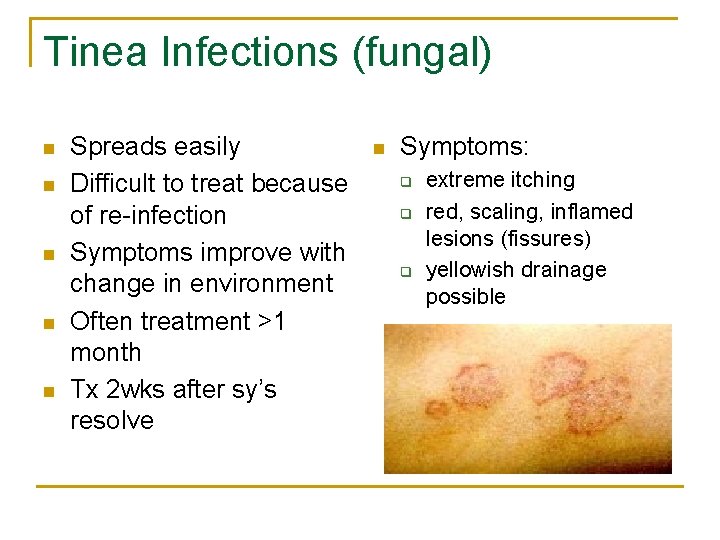 Tinea Infections (fungal) n n n Spreads easily Difficult to treat because of re-infection