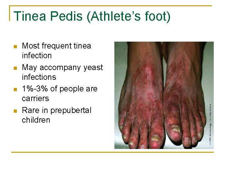 Tinea Pedis (Athlete’s foot) n n Most frequent tinea infection May accompany yeast infections