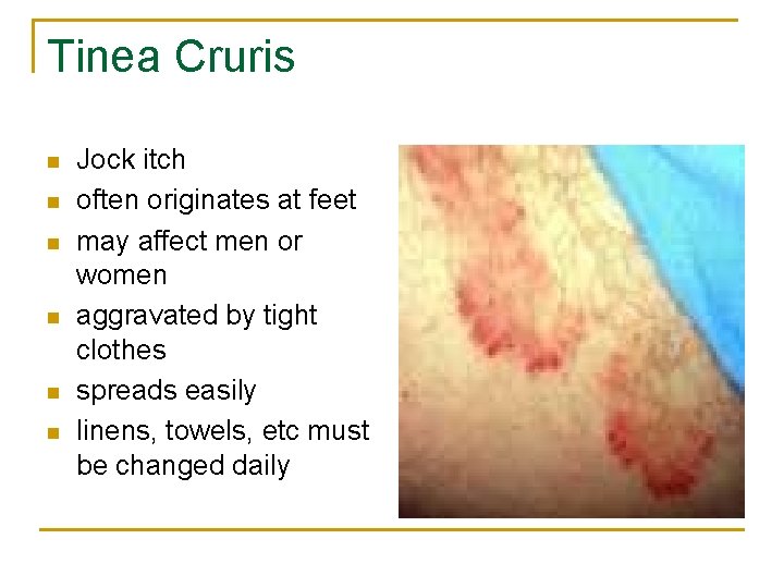 Tinea Cruris n n n Jock itch often originates at feet may affect men