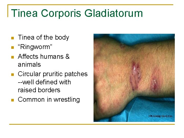 Tinea Corporis Gladiatorum n n n Tinea of the body “Ringworm” Affects humans &