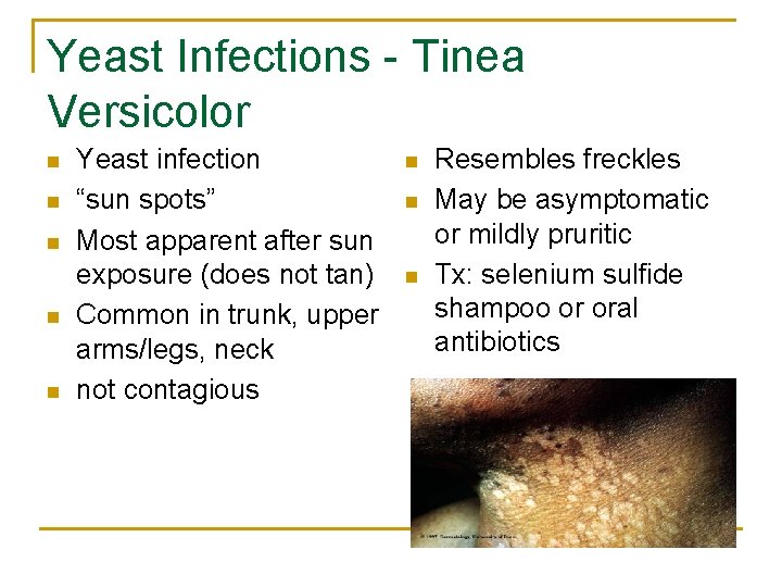 Yeast Infections - Tinea Versicolor n n n Yeast infection “sun spots” Most apparent