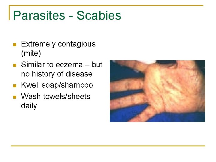 Parasites - Scabies n n Extremely contagious (mite) Similar to eczema – but no