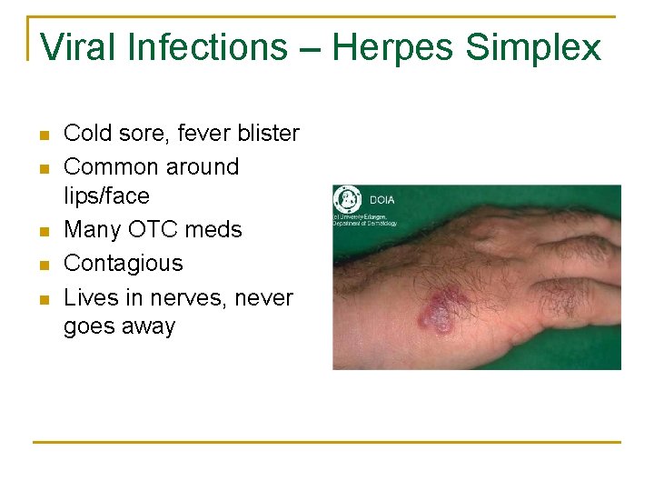 Viral Infections – Herpes Simplex n n n Cold sore, fever blister Common around