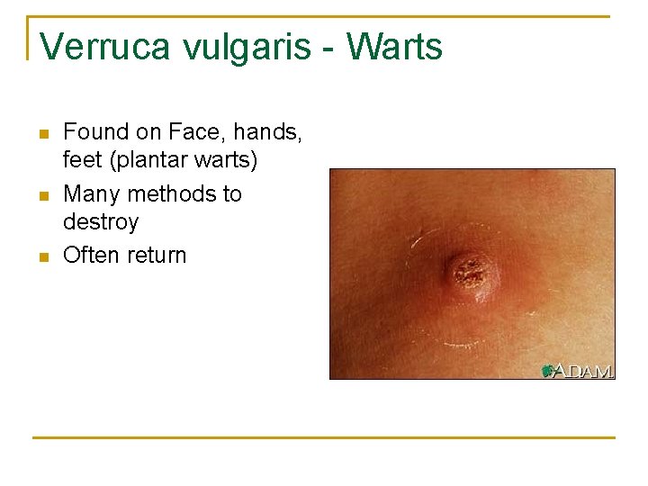 Verruca vulgaris - Warts n n n Found on Face, hands, feet (plantar warts)