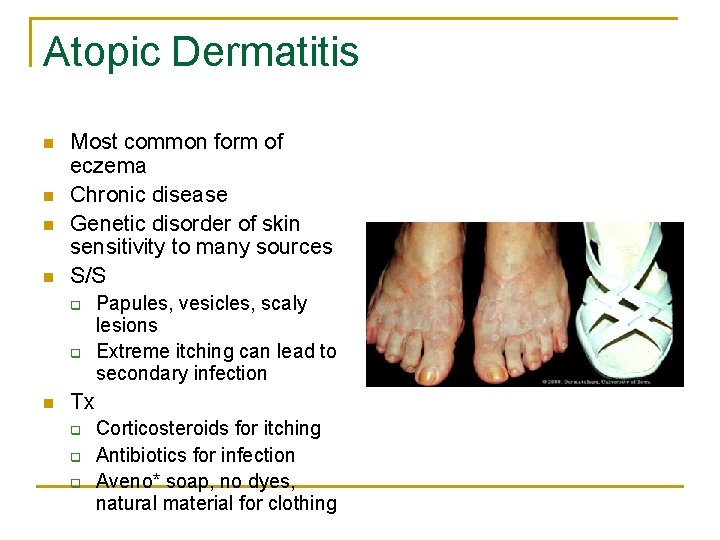 Atopic Dermatitis n n Most common form of eczema Chronic disease Genetic disorder of