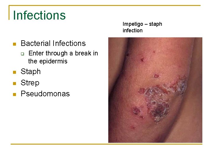 Infections n Bacterial Infections q n n n Enter through a break in the