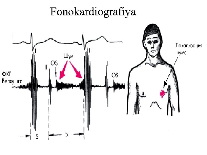 Fonokardiografiya Fonokardiografiya