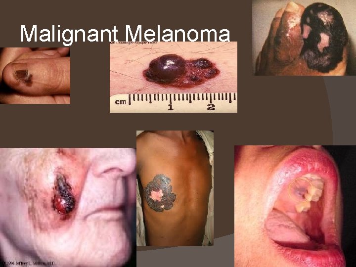 Malignant Melanoma 