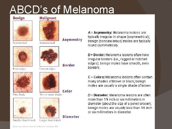 ABCD’s of Melanoma 