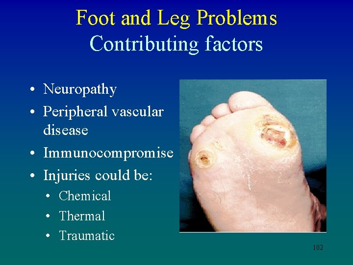 Foot and Leg Problems Contributing factors • Neuropathy • Peripheral vascular disease • Immunocompromise