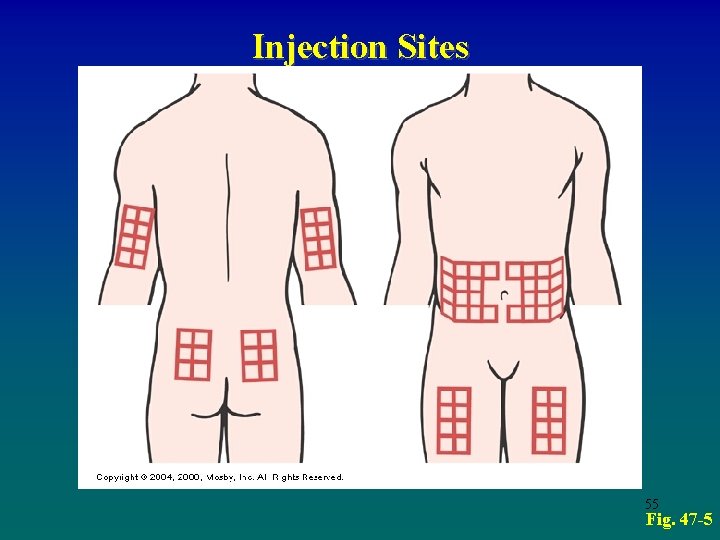 Injection Sites 55 Fig. 47 -5 