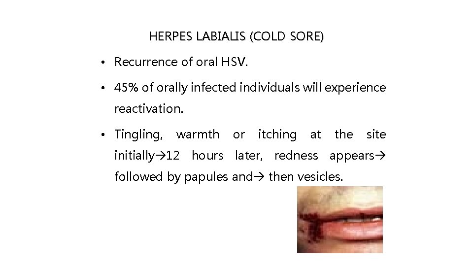 HERPES LABIALIS (COLD SORE) • Recurrence of oral HSV. • 45% of orally infected