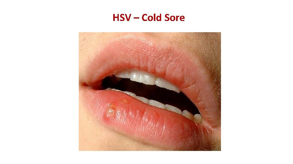 HSV – Cold Sore 