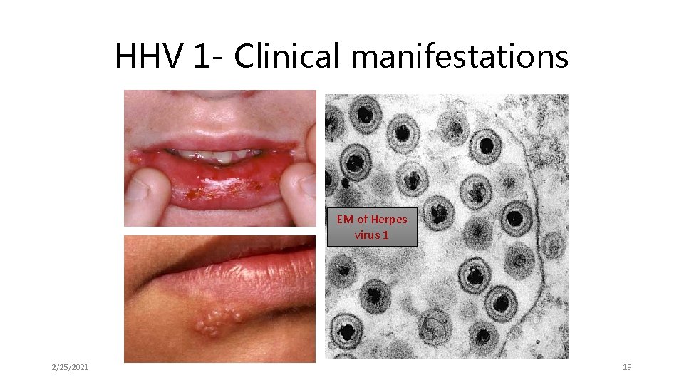 HHV 1 - Clinical manifestations EM of Herpes virus 1 2/25/2021 19 