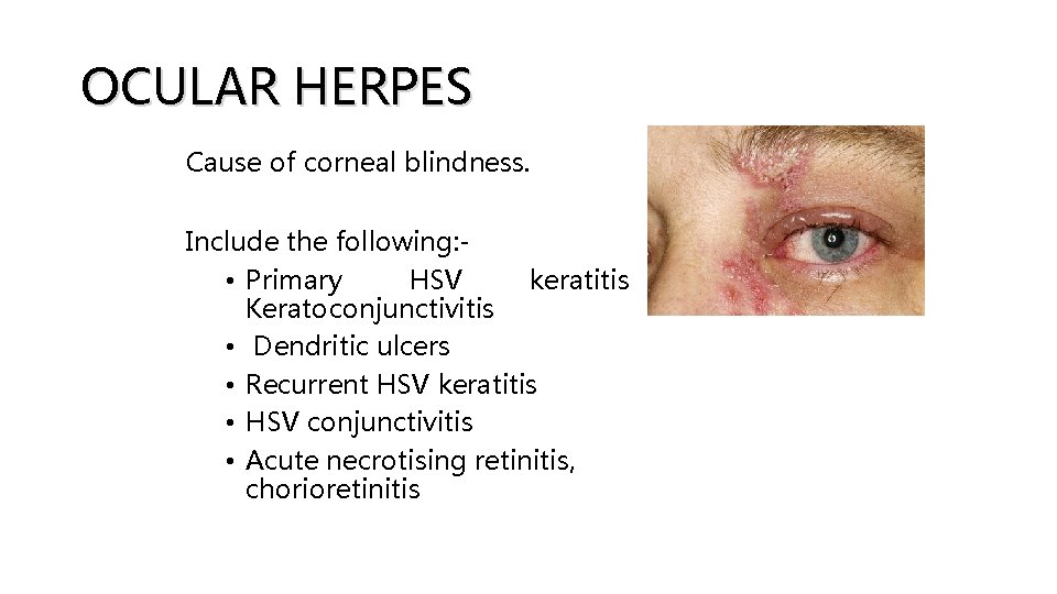 OCULAR HERPES Cause of corneal blindness. Include the following: • Primary HSV keratitis Keratoconjunctivitis