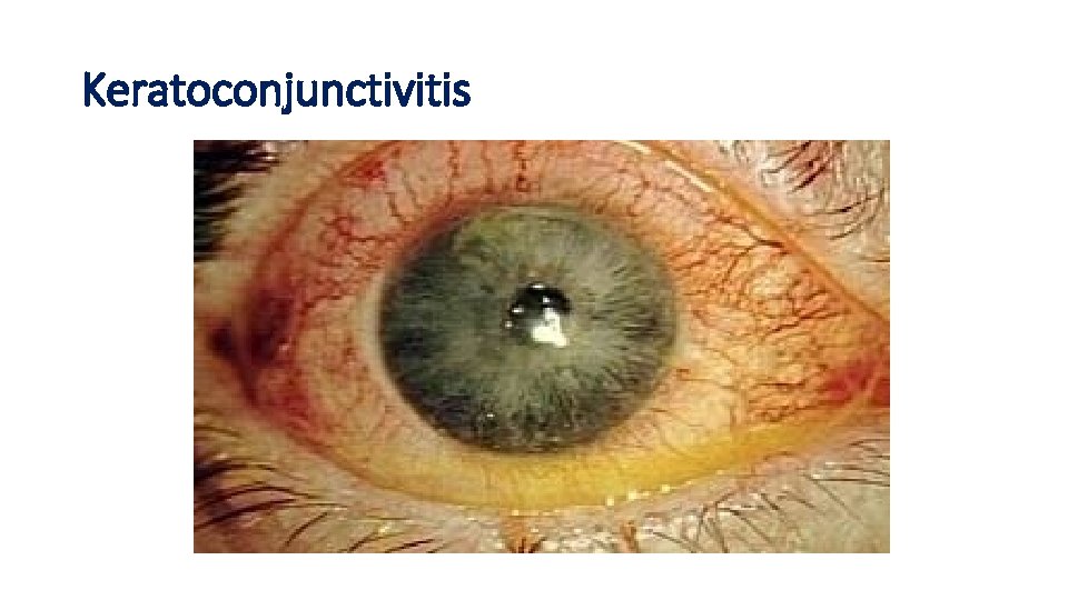 Keratoconjunctivitis 