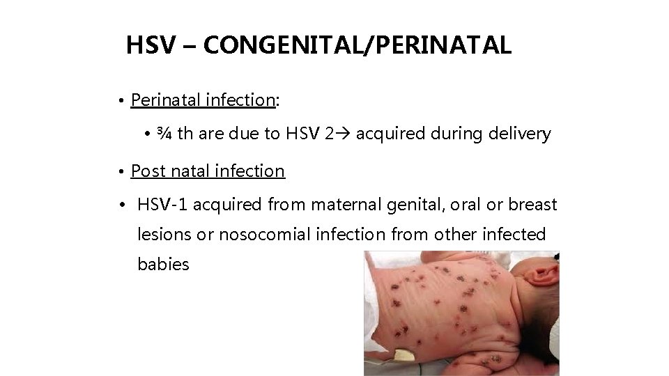HSV – CONGENITAL/PERINATAL • Perinatal infection: • ¾ th are due to HSV 2