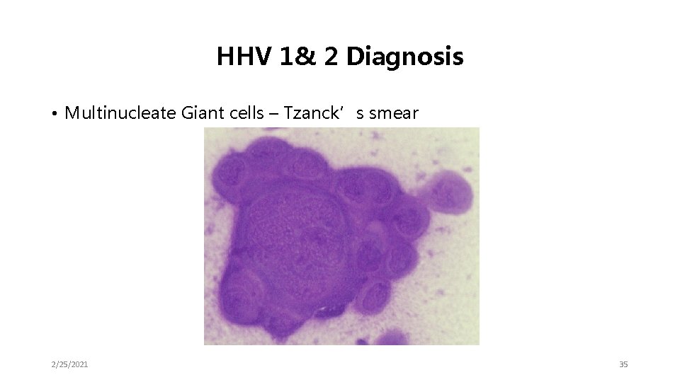 HHV 1& 2 Diagnosis • Multinucleate Giant cells – Tzanck’s smear 2/25/2021 35 